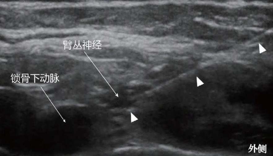 三、超聲引導(dǎo)鎖骨上臂叢阻滯技術(shù)
